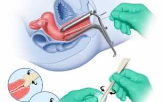 Мазок на ЗППП: процесс забора материала и расшифровка результатов