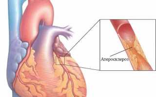 Коронаросклероз