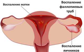 Причины и лечение болезненного течения менструации