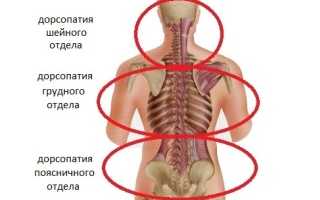 Лечим дорсопатию позвоночника