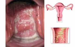 Кольпит: особенности заболевания