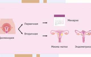 Что такое первичная и вторичная дисменорея, каковы её симптомы и способы лечения
