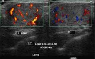 Эхогенность щитовидной железы – ранняя диагностика патологий