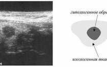 Симптомы и лечение гипоэхогенного образования