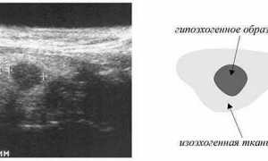 Симптомы и лечение гипоэхогенного образования