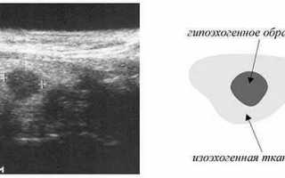 Симптомы и лечение гипоэхогенного образования