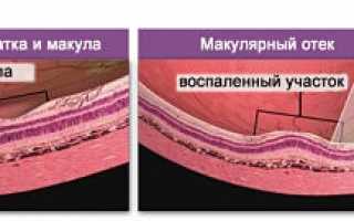 Особенности развития, диагностики и лечения макулярного отека