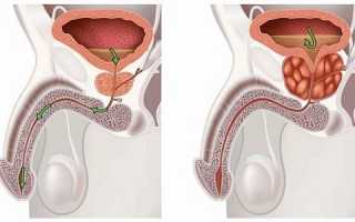 Как проявляется гнойный простатит?