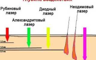 Как проходит и работает лазерная эпиляция: вся правда о процедуре удаления волос