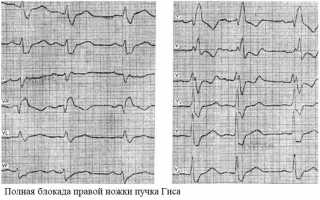 Замедление проводимости по правой ножке пучка Гиса