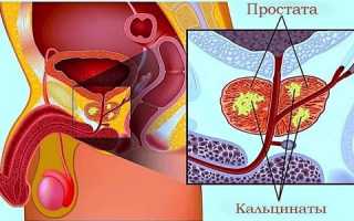 Что такое калькулезный простатит: как проявляется и лечится