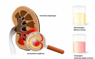 Что значит повышенный уробилиноген в моче?