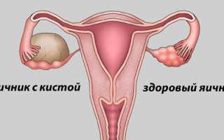 Проблема задержки месячных при кисте яичника и как восстановить цикл?