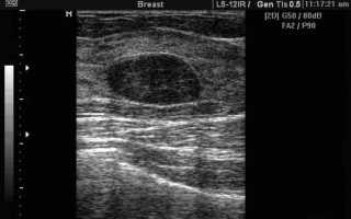 О каком заболевании говорит гипоэхогенное образование на УЗИ