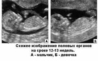 По каким признакам определяется пол ребенка на УЗИ