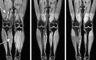 Визуализирующие возможности МРТ нижних конечностей