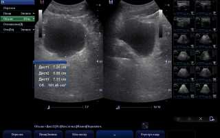 Как определить объем мочевого пузыря на УЗИ