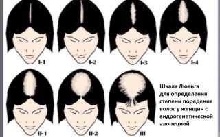 Диагноз алопеция: это что?