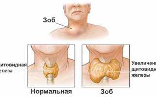 Увеличение щитовидной железы