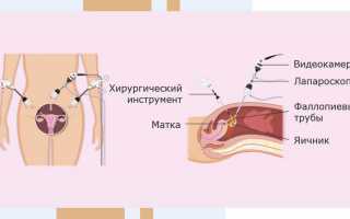 Причины, симптомы и лечение фолликулярной кисты правого или левого яичника