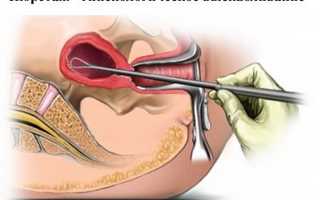 Сколько длятся выделения у женщин после выскабливания полости матки