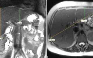 Размеры печени