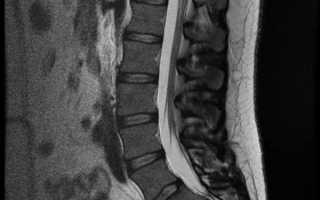 Магнитно-резонансная томография позвоночника