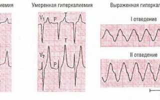 Диета при повышенном калии в крови