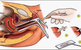 Можно ли безопасно сдавать гинекологический мазок во время месячных?