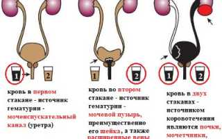 Причины появления и методы лечения крови в моче при простатите