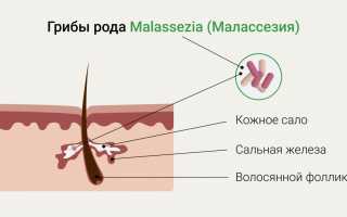 Что такое дрожжевой грибок у женщин и как его лечить?