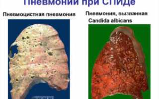 Заболевание пневмонией у ВИЧ инфицированных