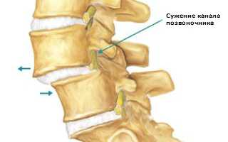 Подробно о спондилолистезе поясничного отдела позвоночника