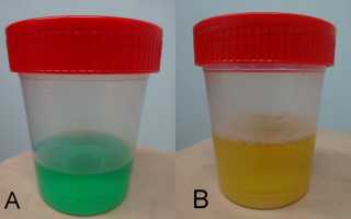 Моча зеленого цвета: о чем это может говорить?