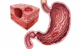Гастродуоденит: симптомы и лечение у взрослых и детей