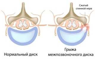 Всё о симптомах и лечении межпозвоночной грыжи пояснично-крестцового отдела!