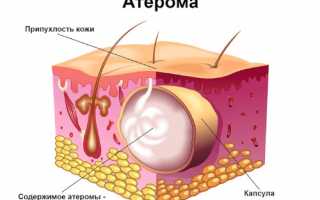 Особенности удаления атеромы
