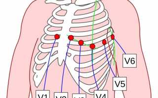 Как правильно наложить электроды при выполнении ЭКГ