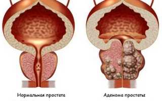 Что такое аденоматозный узел предстательной железы: симптомы и лечение