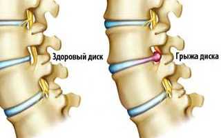 Способы лечения грыжи пояснично-крестцового отдела