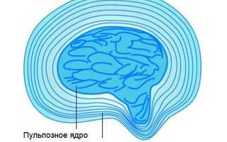 Лечение протрузии межпозвонковых дисков
