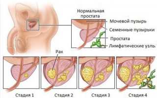 Особенности терапии рака предстательной железы 4 степени