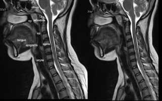 Что показывает МРТ горла и гортани