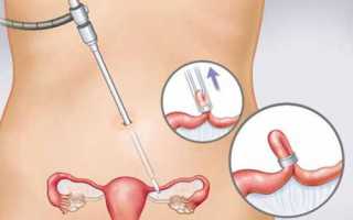 Характер менструации после лапароскопической операции