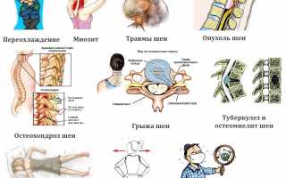 Защемление нерва в шейном отделе