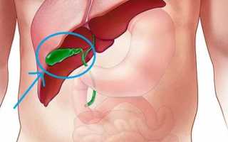 Загиб желчного пузыря: симптомы и методы лечения у детей и взрослых
