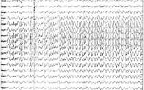 Диффузные изменения биоэлектрической активности мозга на ЭЭГ
