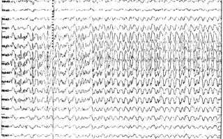 Диффузные изменения биоэлектрической активности мозга на ЭЭГ