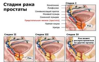 Эффективные препараты для лечения рака простаты