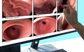 Подготовка к процедуре ФГДС (гастроскопии)